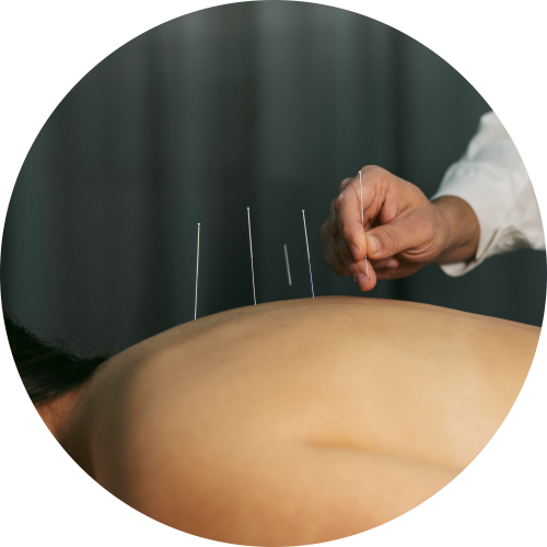 Acupuntura